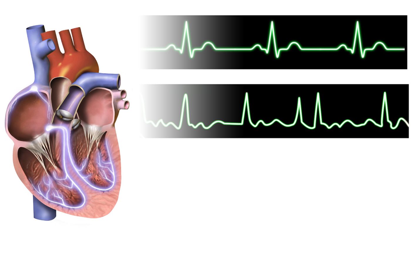 Artistic rendering of atrial fibrillation. Credit: Bruce Blaus