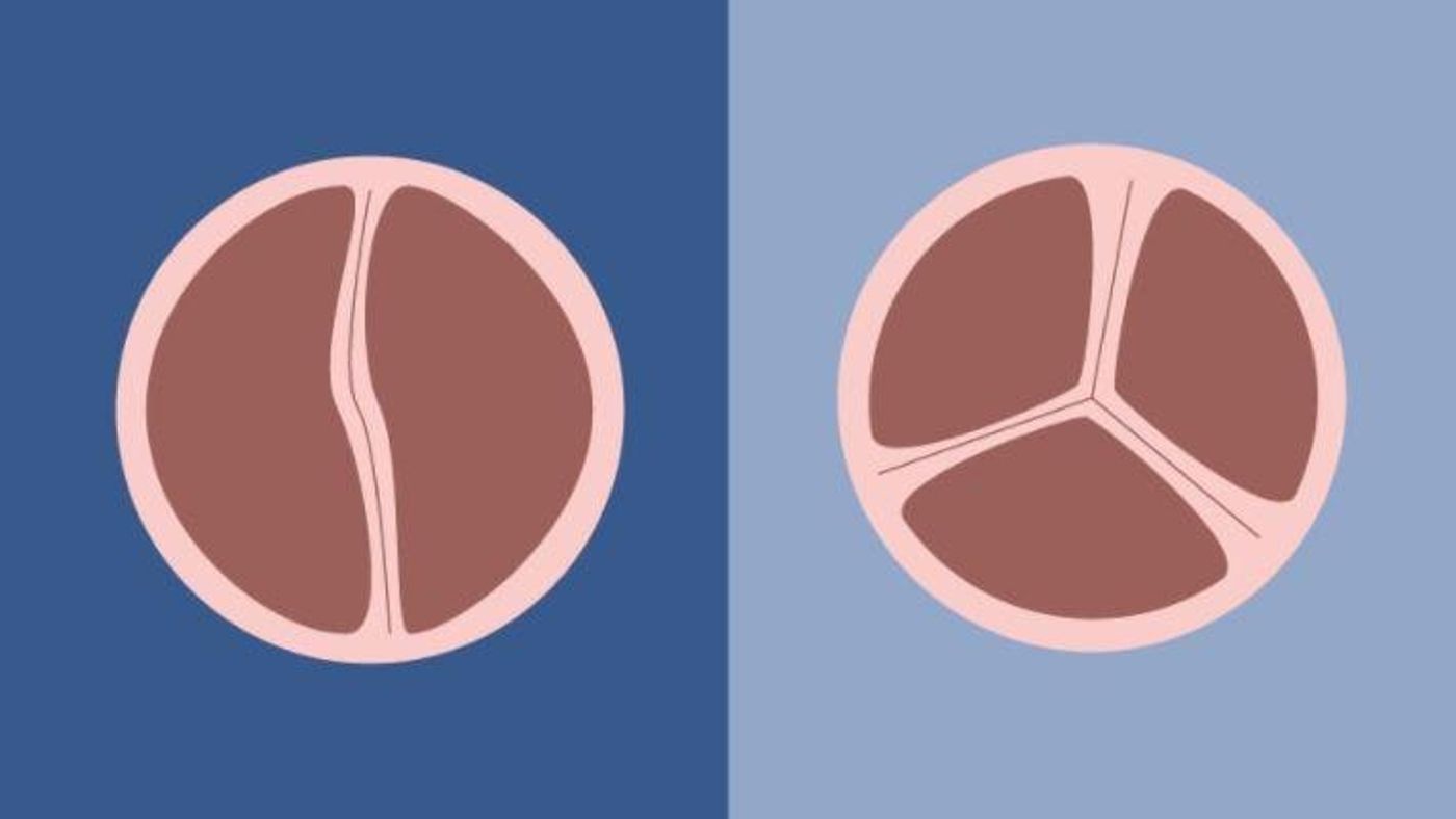 Researchers report a key protein is affected during heart valve formation, in the first genome-wide study of bicuspid aortic valve. Credit: Michigan Medicine