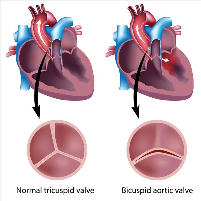 NOTCH Pathway Contributes to Congenital Aortic Valve Disease Cardiology