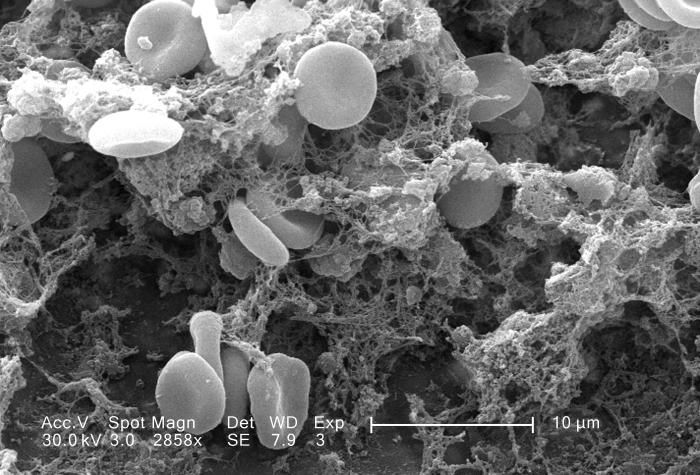 A scanning electron micrograph depicted a number of red blood cells found clotted together.