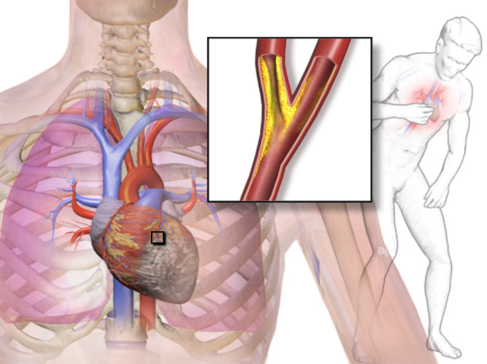 When arteries feeding blood to the heart become blocked, heart attack occurs. Credit: Blausen.com staff (2014)