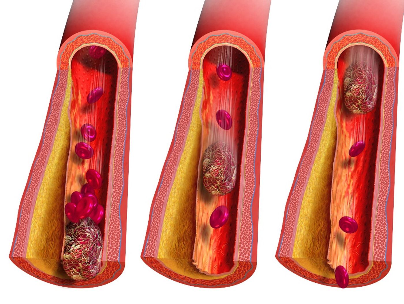 An embolism traveling through a blood vessel.