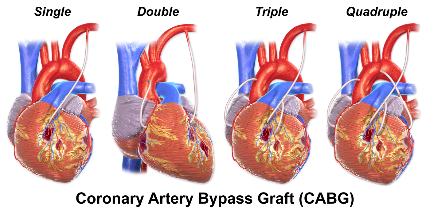 Guidelines Refined For Coronary Artery Bypass Grafting Cardiology And 