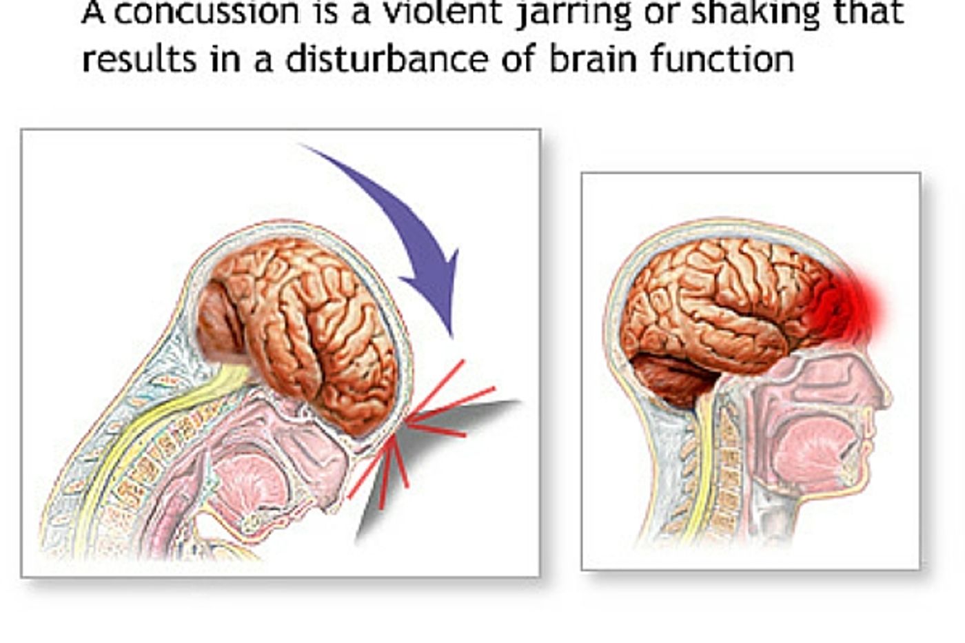 The NFL now admits that football injuries cause CTE