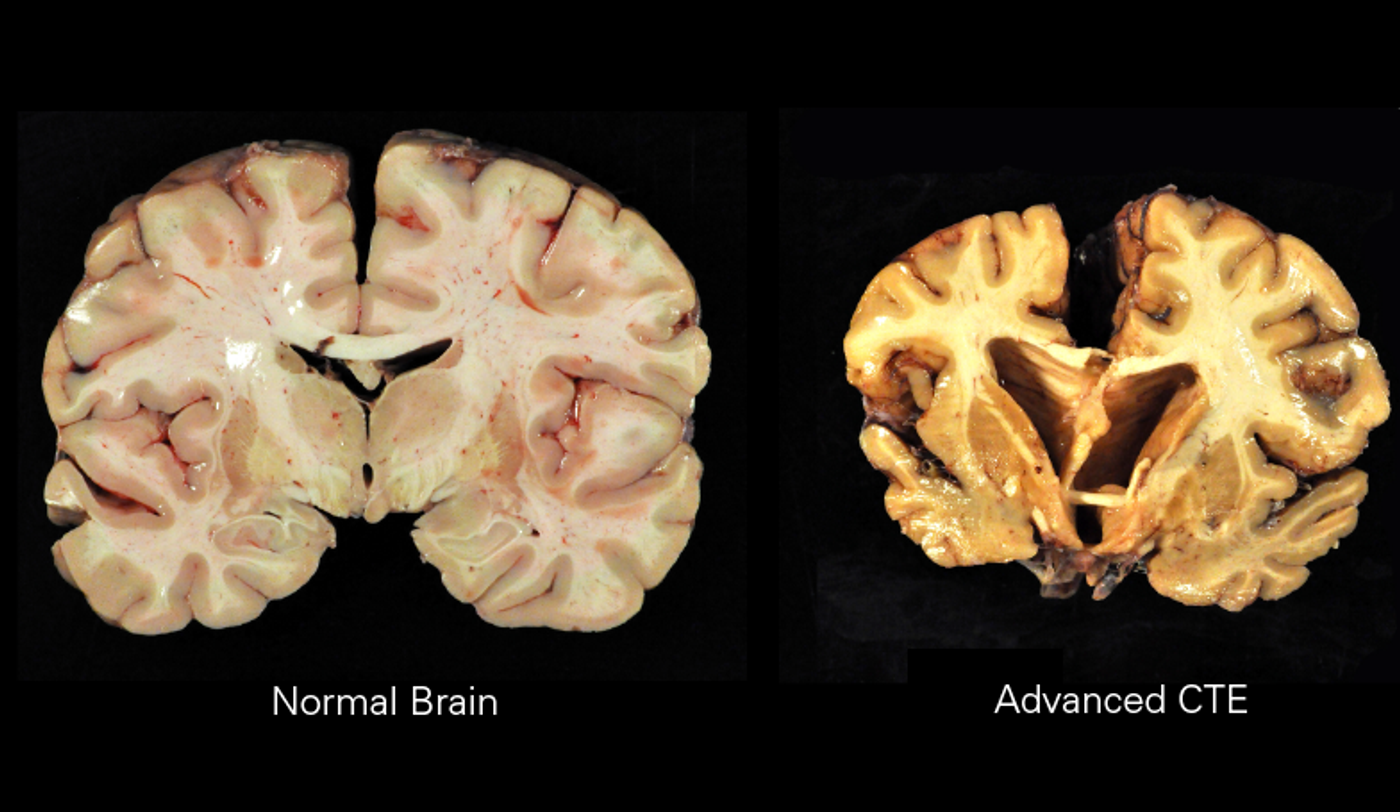 Image of chronic traumatic encephalopathy Date	17 October 2014 Source	http://www-tc.pbs.org/wgbh/pages/frontline/art/progs/concussions-cte/h.png Author	Boston University Center for the Study of Traumatic Encephalopathy