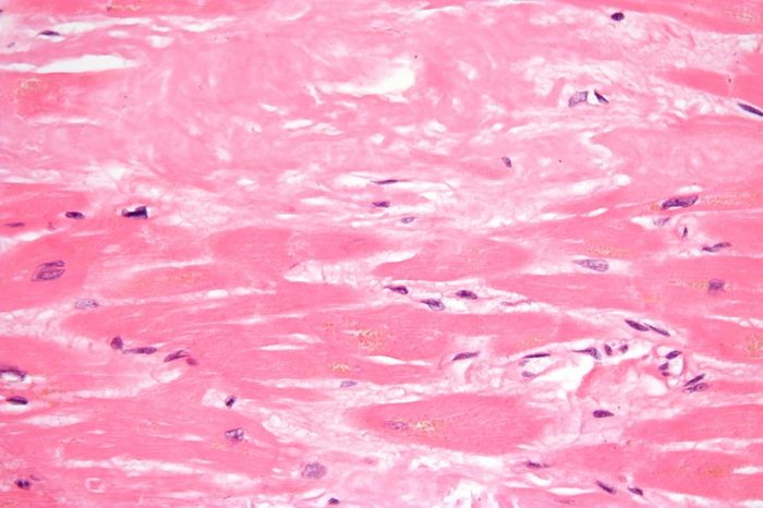 Amyloid (extracellular fluffy pink material) and abundant lipofuscin (yellow granular material). Source: Wikimedia Commons