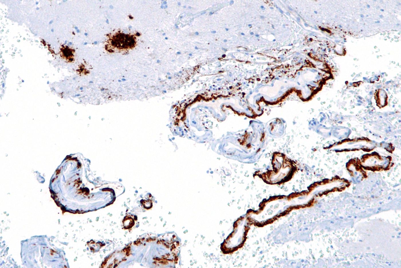 Beta-amyloid plaques
