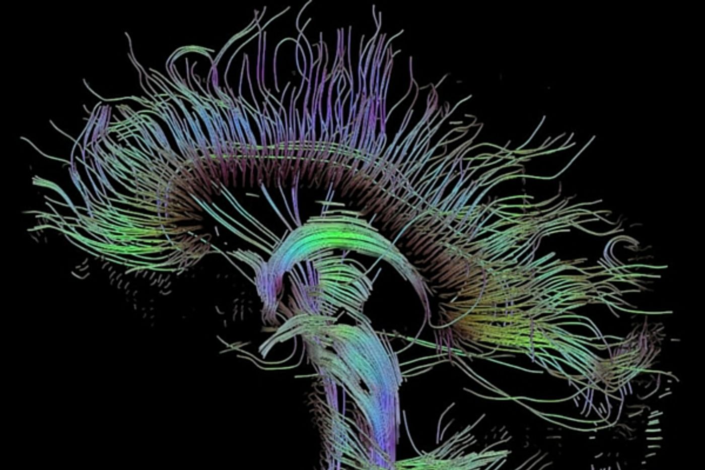 A certain kind of high tech MRI can see brain structures better