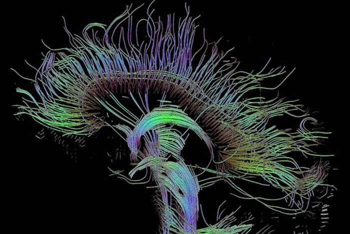 A certain kind of high tech MRI can see brain structures better