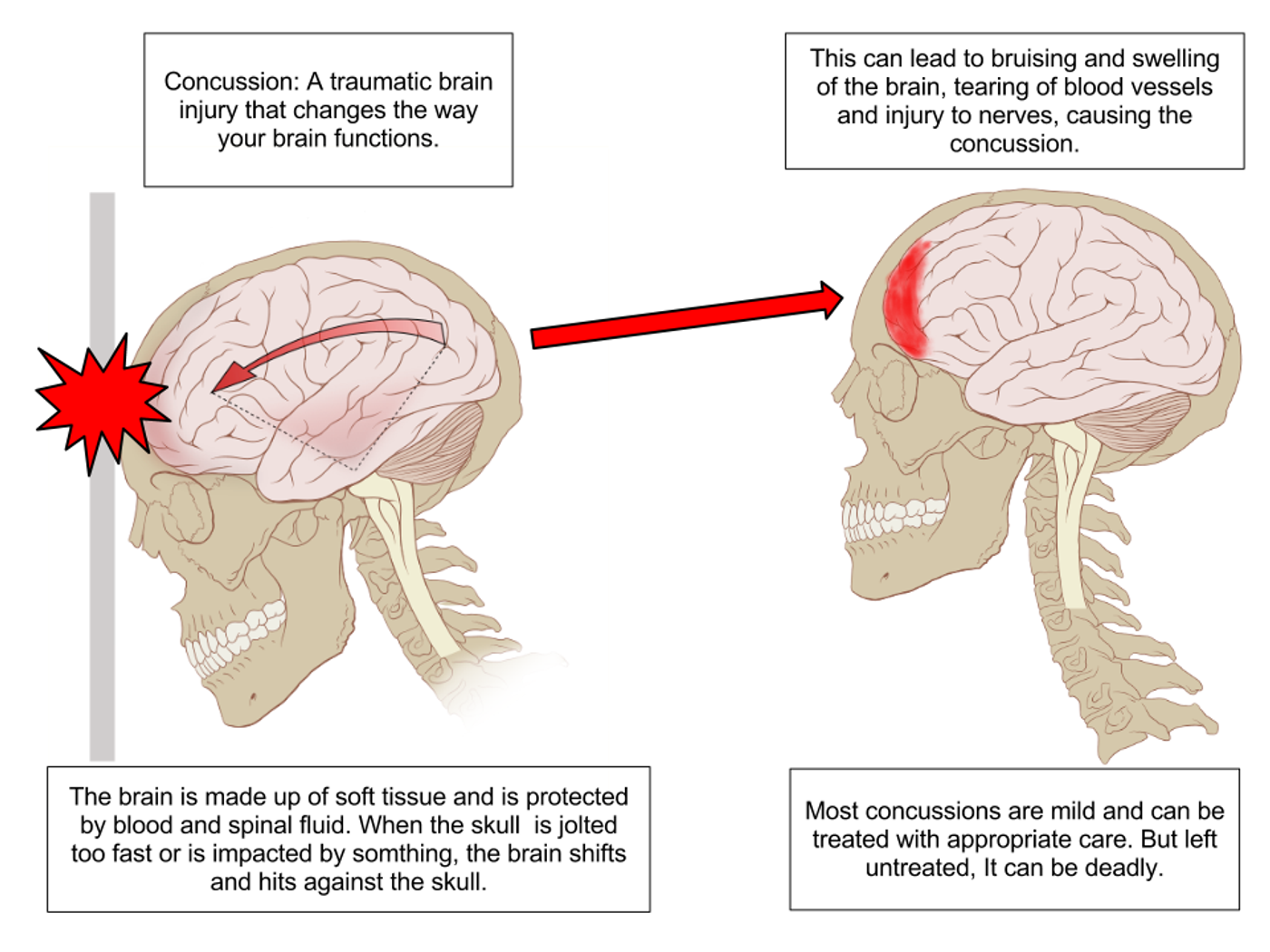 This is your brain after head trauma