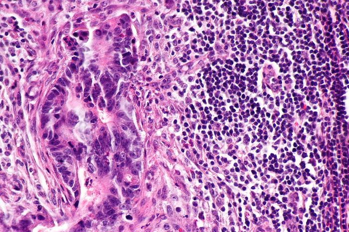 Micrograph of lymph node with colorectal carcinoma. Credit: Wikimedia user Nephron