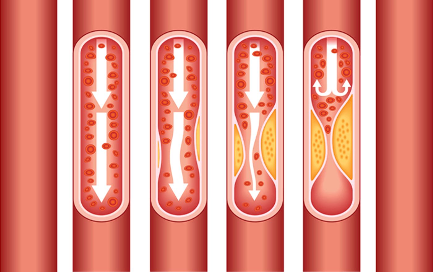 An example of how calcification clogs arteries and inhibits blood and oxygen flow