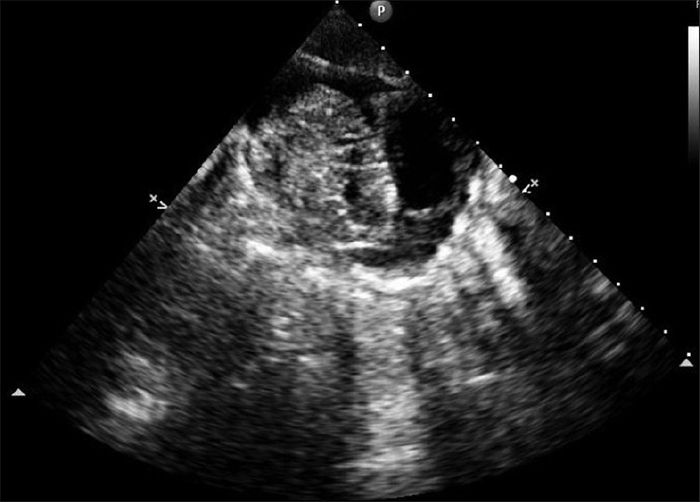 Echocardiogram revealed an intrapericardial, predominantly solid mass with several small cystic areas associated with pericardial effusion. Source: Clinical Cancer Investigation Journal