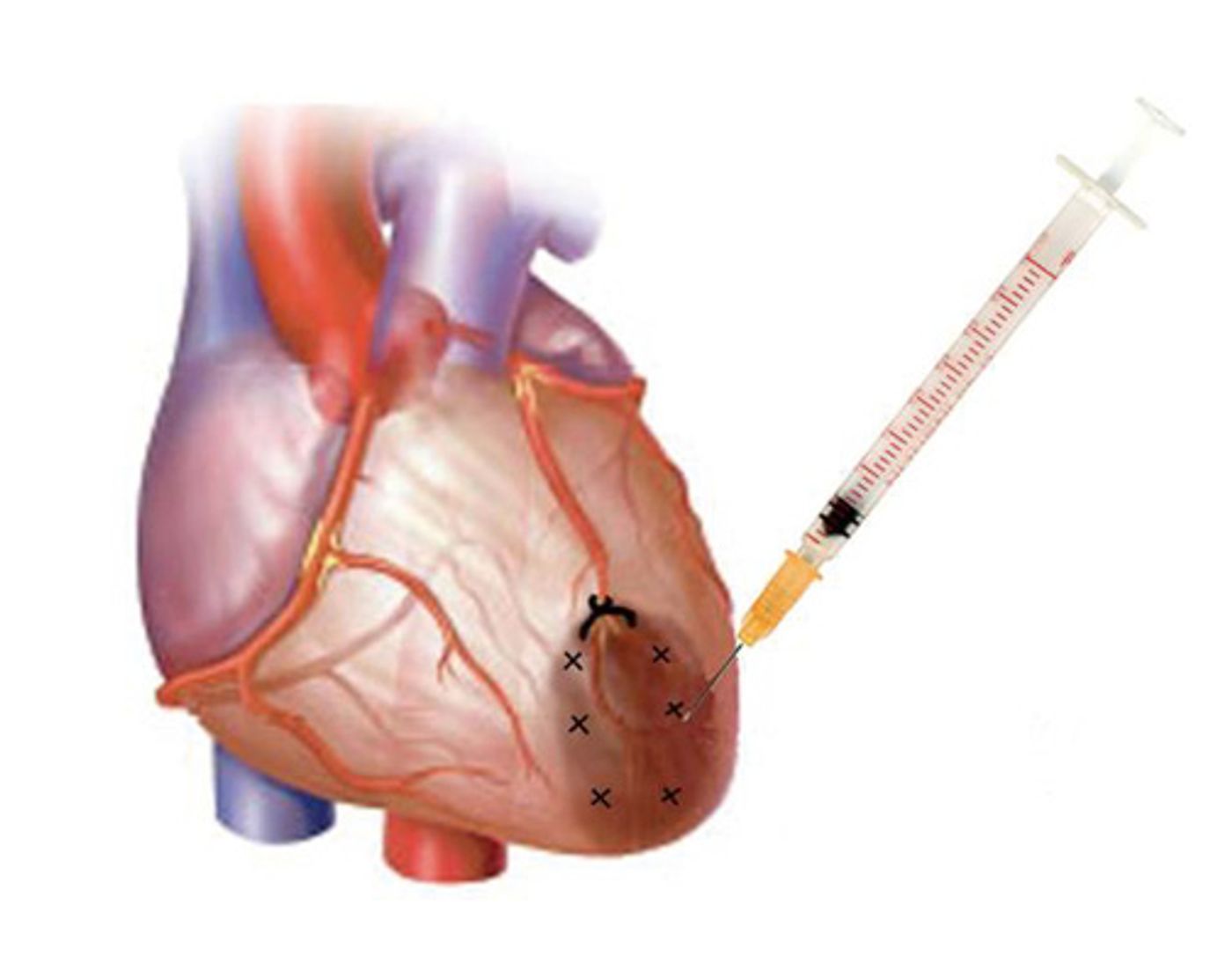 Intramyocardial Injection