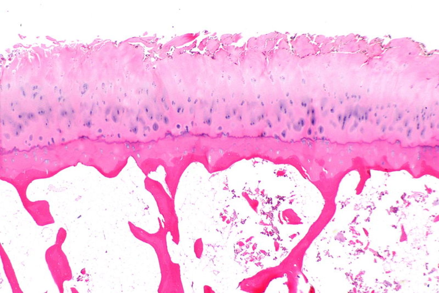 Micrograph showing degenerative joint disease compatible with osteoarthritis. Credit: Nephron