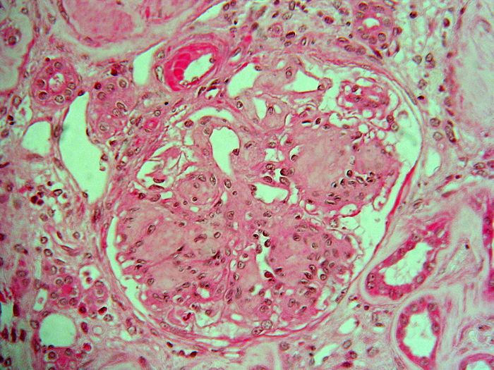 Light micrograph of a kidney showing nodular glomerulosclerosis in a case of diabetic nephropathy. Credit: Doc.mari