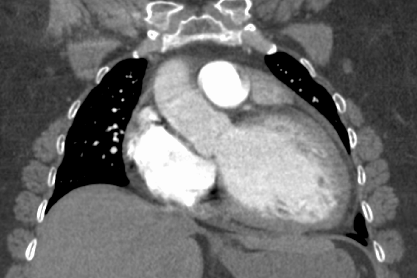 A CT image of dilated cardiomyopathy. Credit: James Heilman, MD