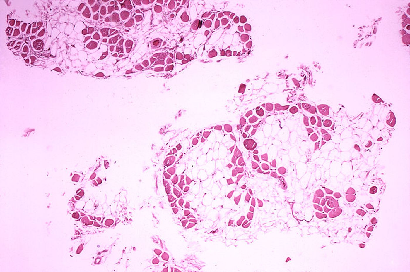Histopathology of gastrocnemius muscle from patient who died of Duchenne muscular dystrophy. Muscle shows extensive replacement of muscle fibers by adipose cells. Credit: CDC Public Health Image Library