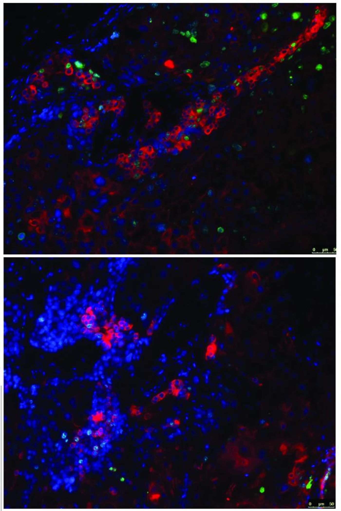 These slides show tumor tissue where ERG and EWS genes interact normally, top, and tumor tissue where ERG has been modified to prevent interaction with EWS, bottom. The green sections indicate cellular proliferation, showing that tumors grow faster when ERG-EWS remains uninhibited. / Credit: Indiana University