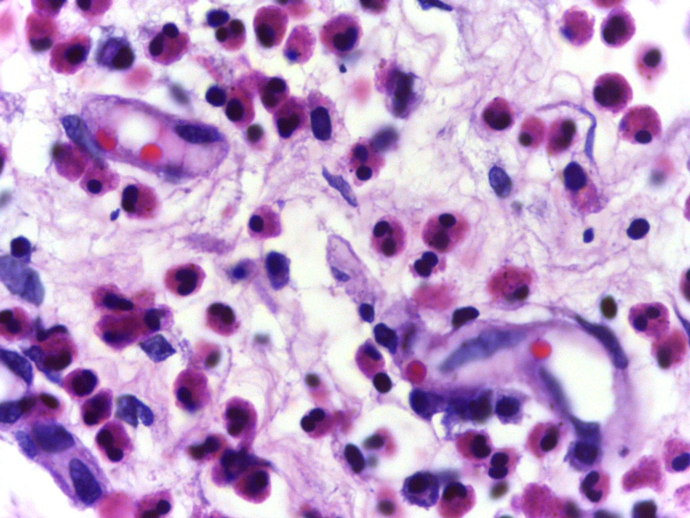 Micrograph showing high power view of Eosinophils. Credit: Department of Pathology, Calicut Medical College