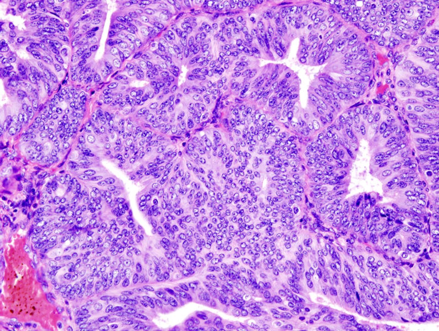 Histopathologic representation of endometrioid adenocarcinoma demonstrated in endometrial biopsy. (Credit: LBiller)