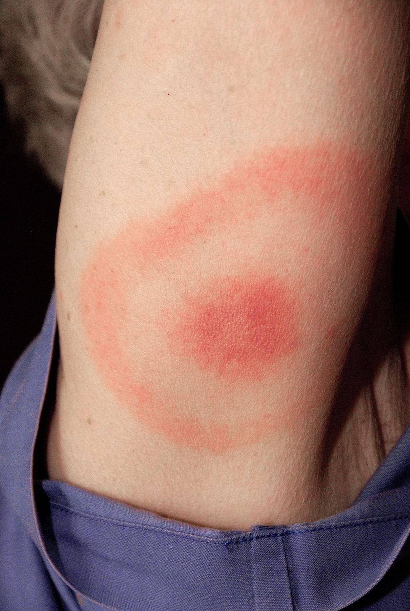 An bull's-eye rash.