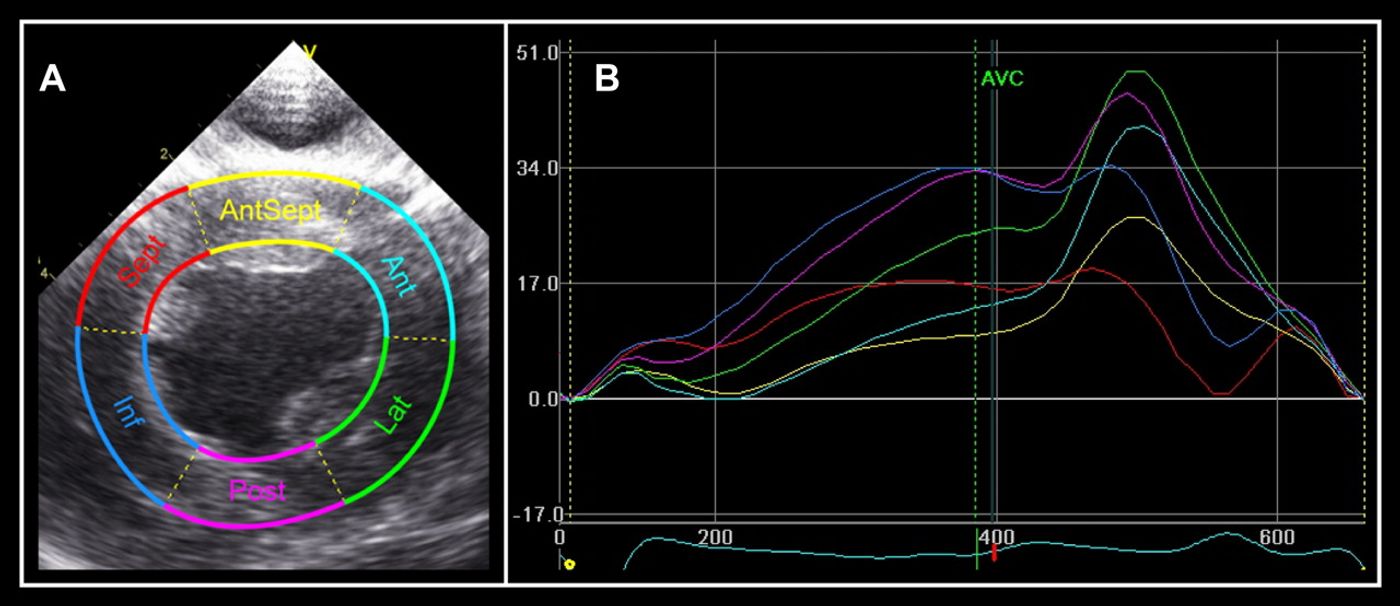 Left ventricular torsion from an ECG