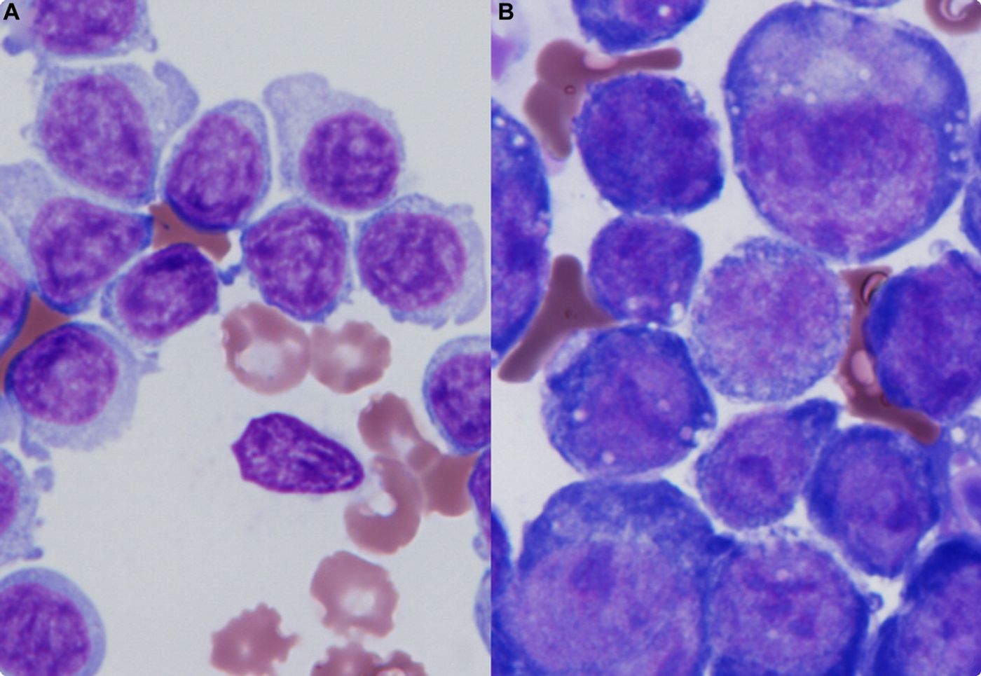 Presence of lymphocytes as an infection progresses