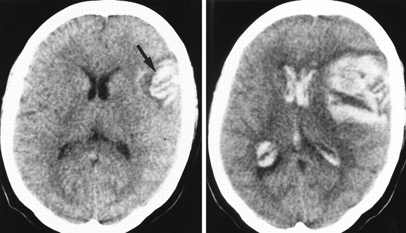 progression of intracerebral brain hemorrhage, arrow points to a cortical hematoma