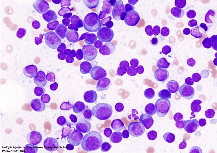 The Microfluidic Device Future Replacement For Bone Marrow Biopsy In Multiple Myeloma Cancer