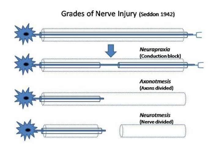 zapping-the-nerves-to-promote-nerve-regeneration-neuroscience