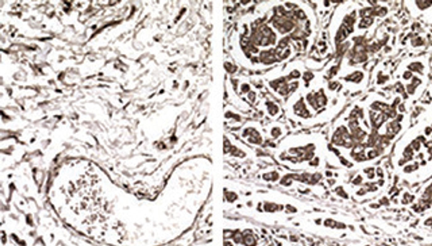 Samples from non-metastatic (left) and metastatic breast cancer (right) cells showing enhanced expression of a specific gene in metastatic tumors because those cells have increased levels of a tRNA called GluUUC.