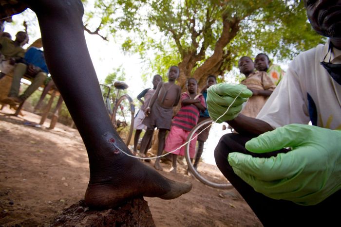 A healthcare worker removes a Guinea worm 