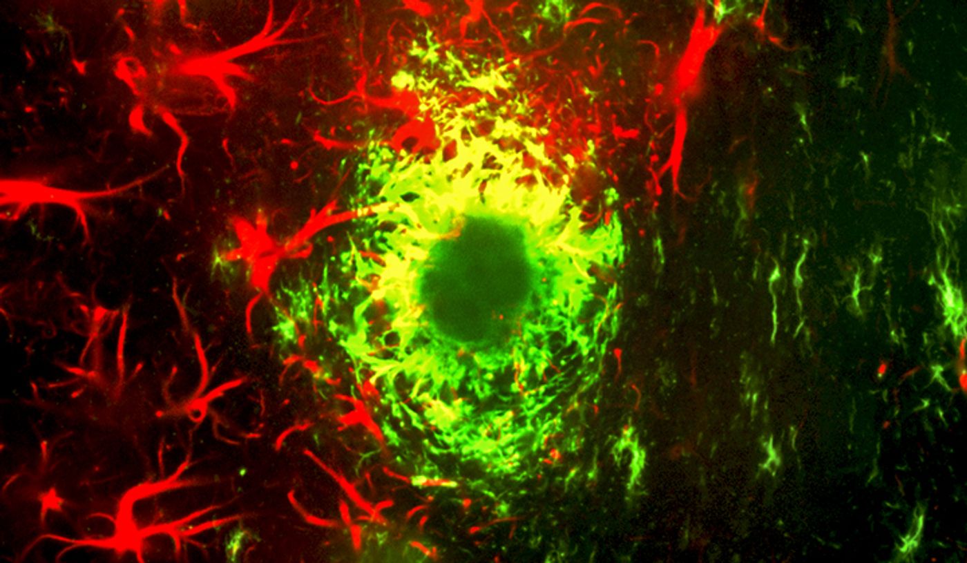 EPFL approached the problem of treating gliomas by combining tricyclic antidepressants with anticoagulant drugs.