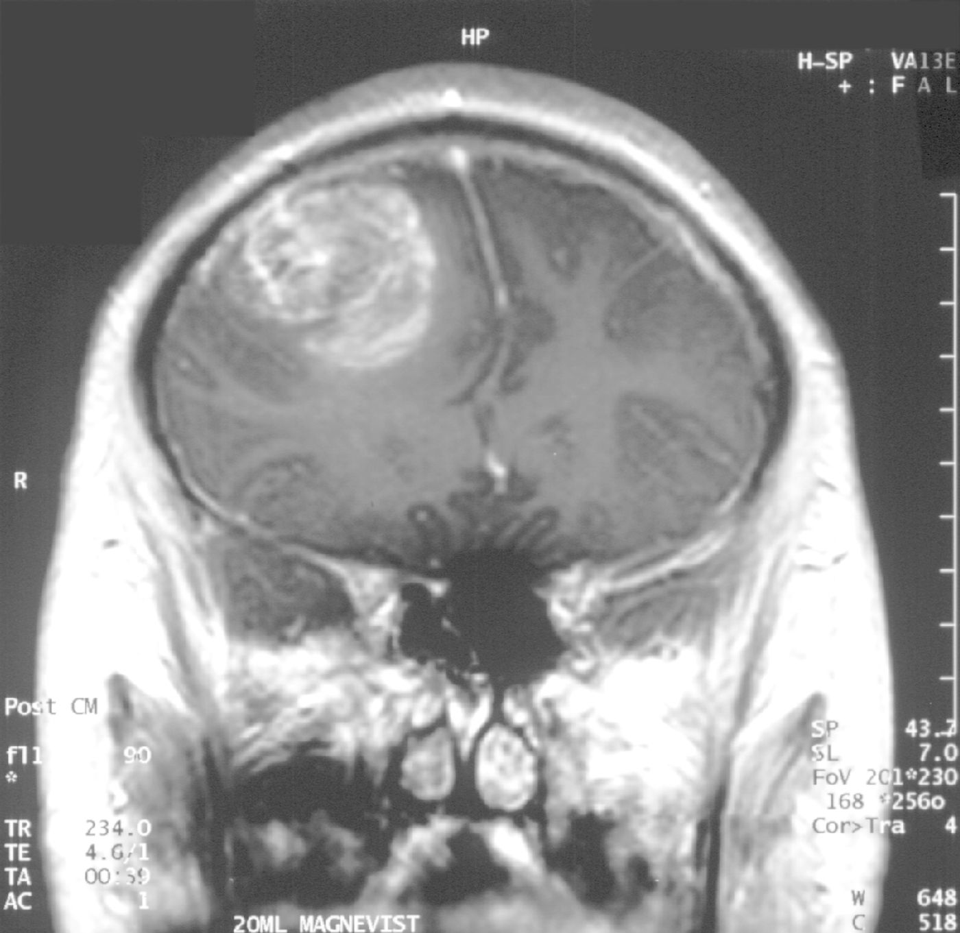 Glioblastoma grade IV.