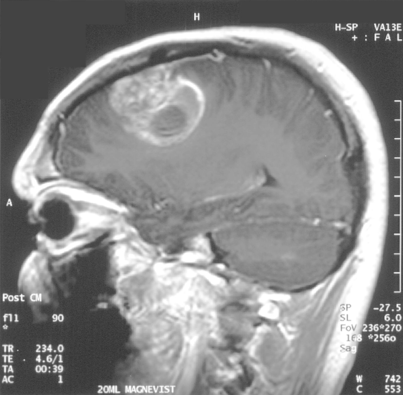 An MRI of a 15-year-old glioblastoma patient. Credit: Christaras A