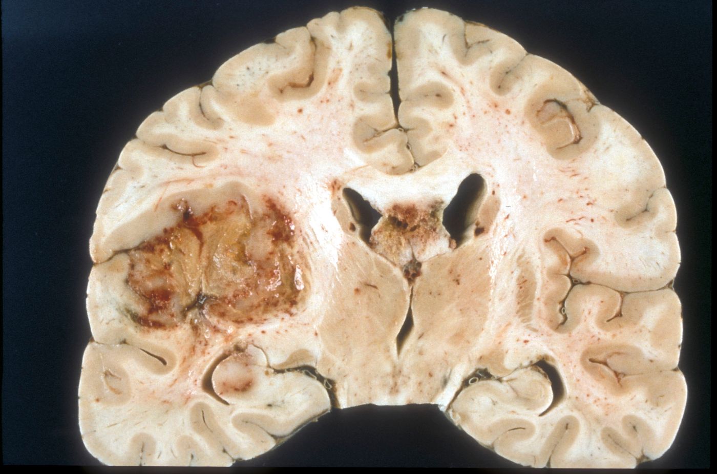 Macroscopic pathology of Glioblastoma multiforme / Credit: Wikimedia Commons / Sbrandner