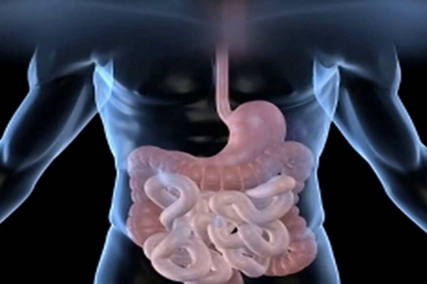 Gut bacteria are affected by strokes
