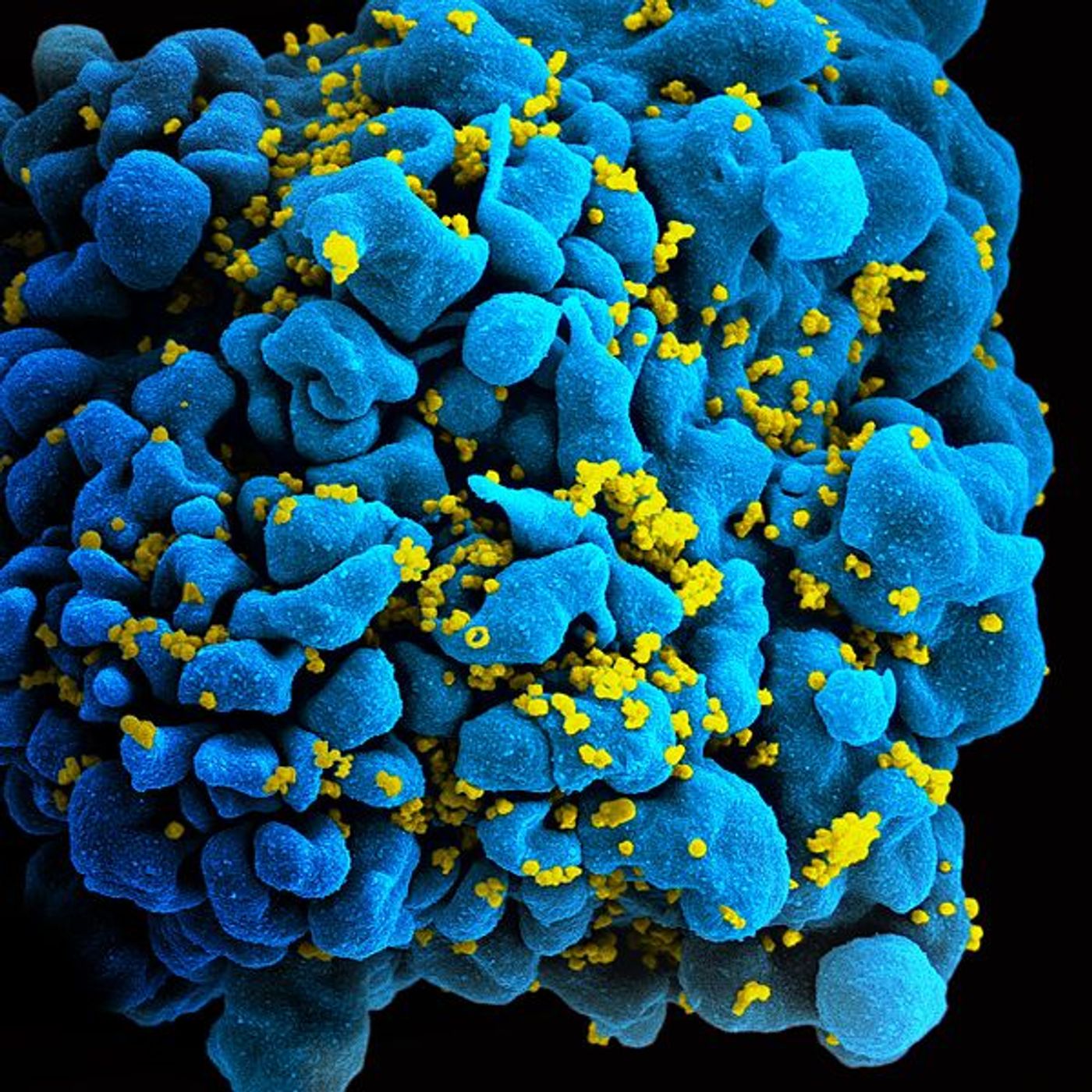 Scanning electromicrograph of an HIV-infected T cell. Credit: NIAID
