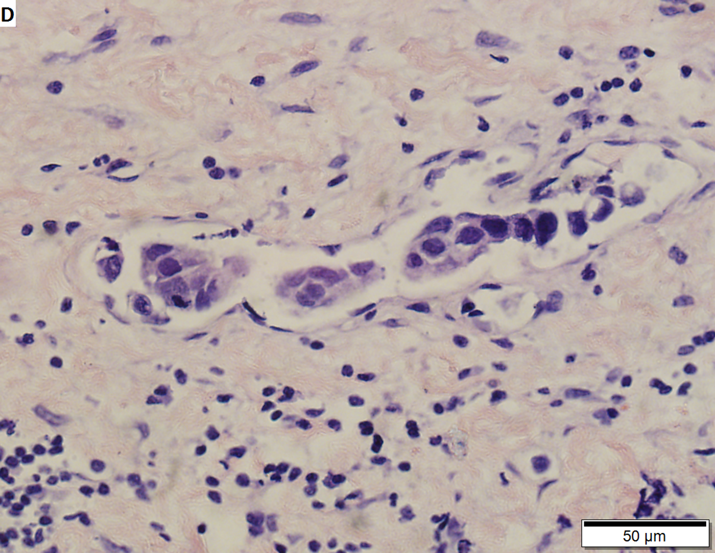 High grade urothelial carcinoma, the most common type of bladder cancer. Credit: TexasPathologistMSW