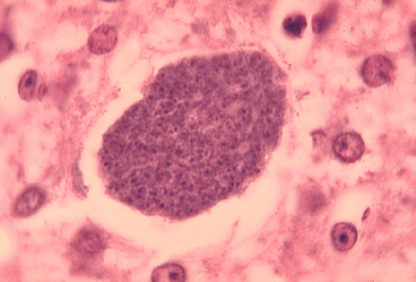 Histopathology of malaria parasite forming in liver. Credit: CDC