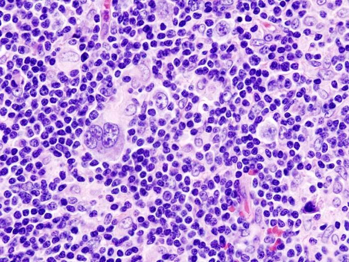 Histopathologic image of Hodgkin's lymphoma, lymph node biopsy. Credit: Wikimedia user KGH