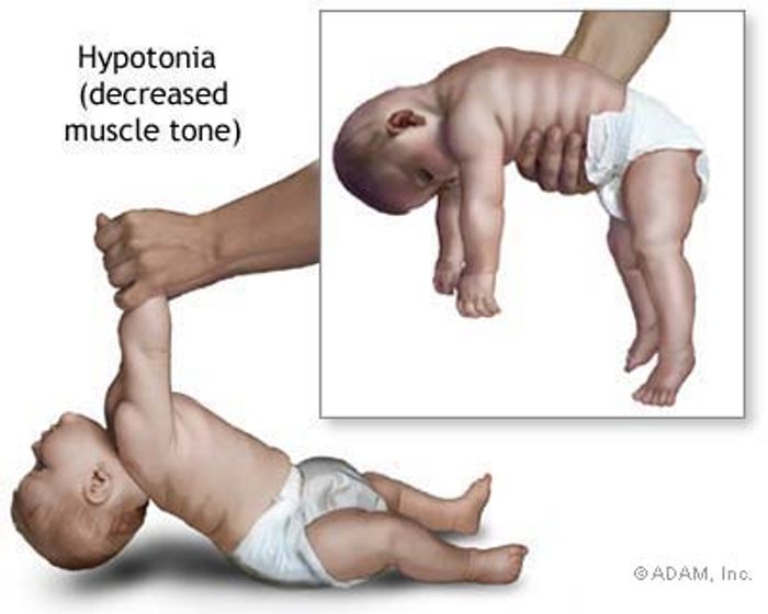 Botulism causes hypotonia