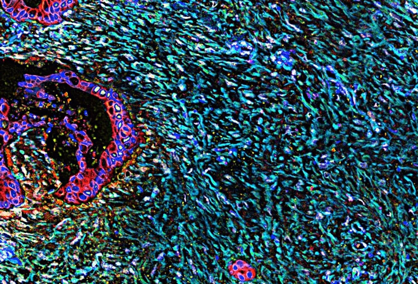 Pancreatic cancer cells (red) surrounded by a vast stroma (cyan). Nuclei are in blue, and this image was created by Neelima Shah and Edna Cukierman.