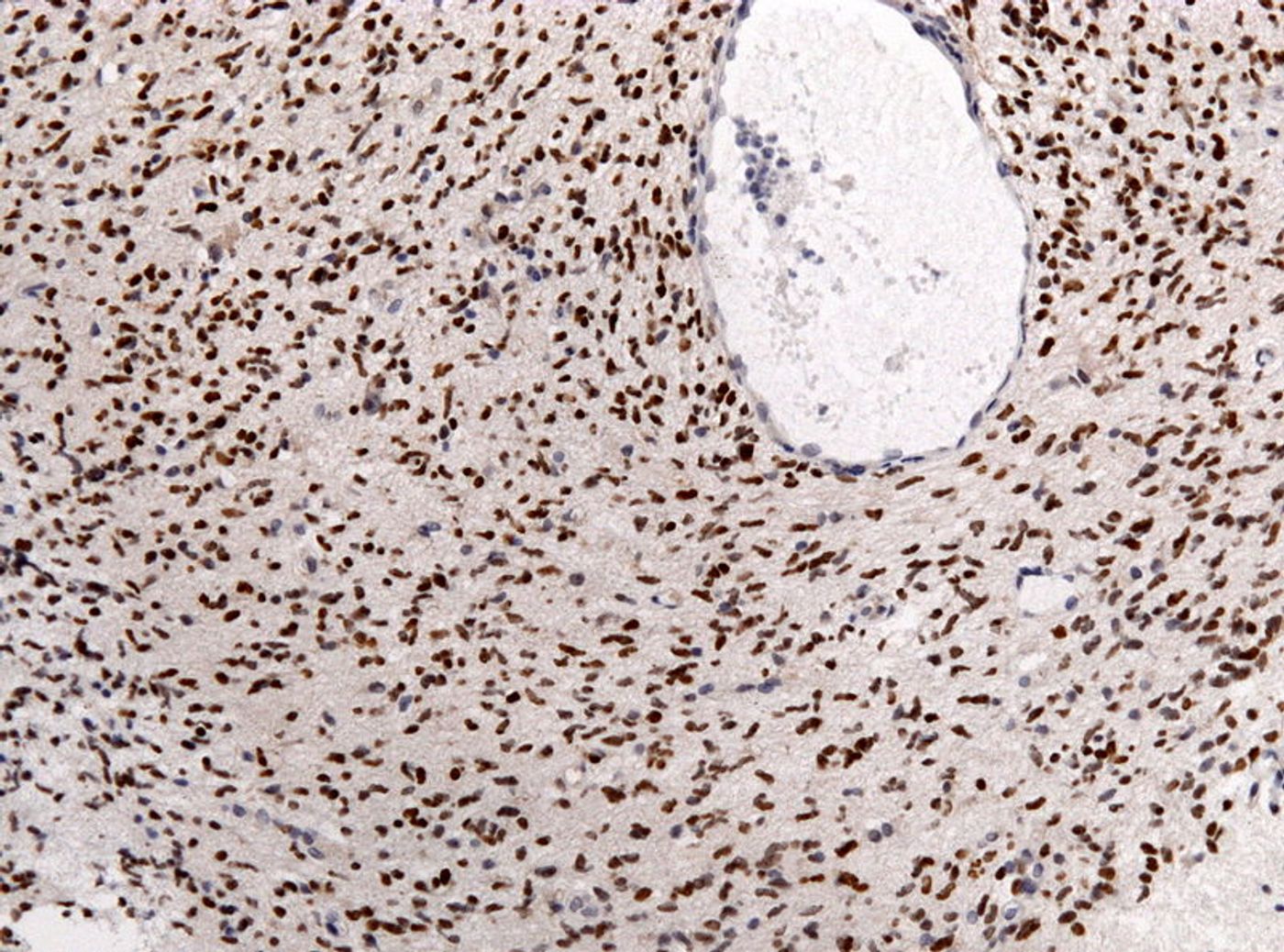 Pathology specimen of a glioma of the midline. Credit: Jensflorian