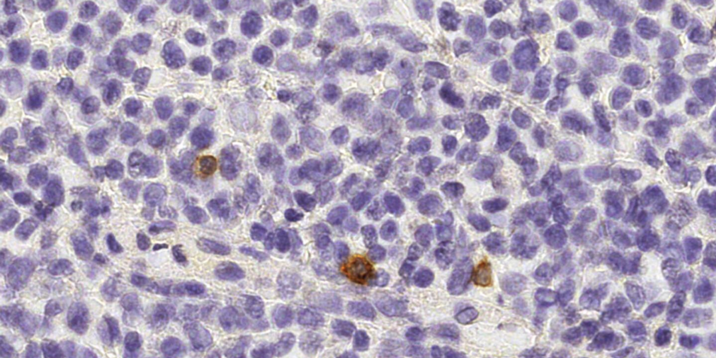NK cells (brown) patrolling between cells of a healthy human lymph node. Source: Institute of Pathology, University of Bern