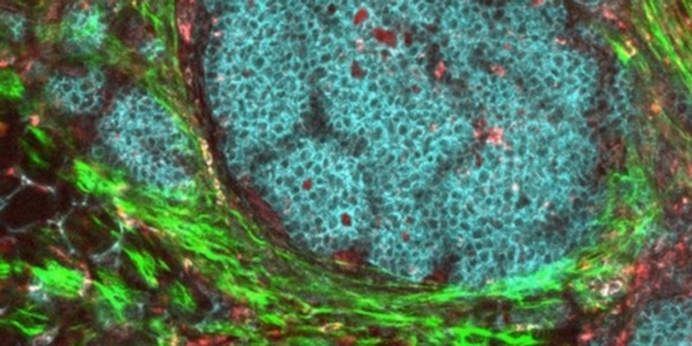 A breast tumor and its local environment. | Image: NCI