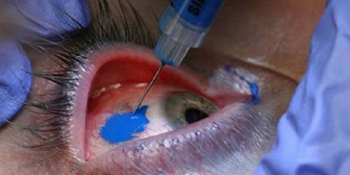 Scleral tattooing | Image credit: Wikipedia.org