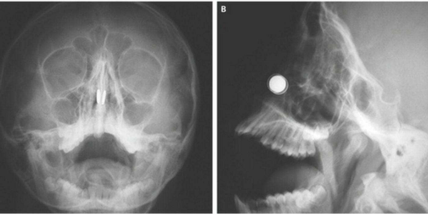 Magnets are the bright white disks. | Image Credit: NEJM