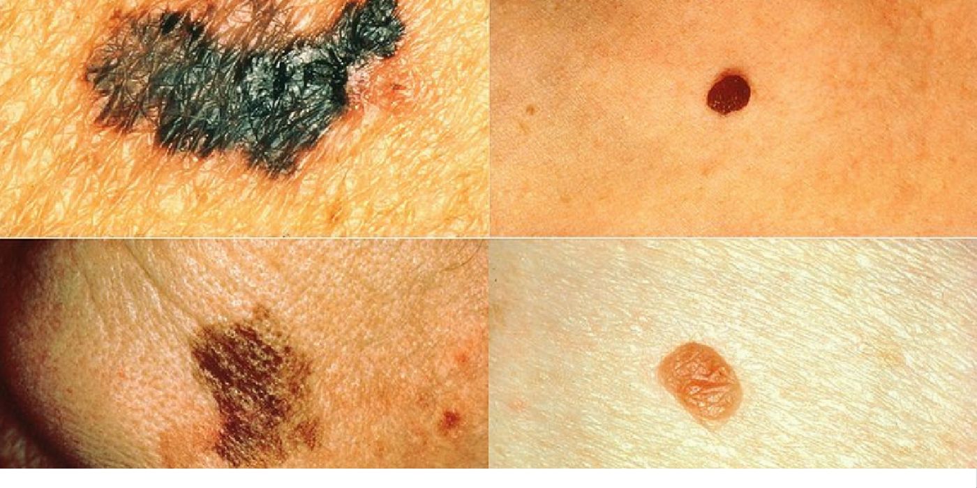 Left: melanomas. Right: normal moles. \\ Image credit: Wikipedia.org